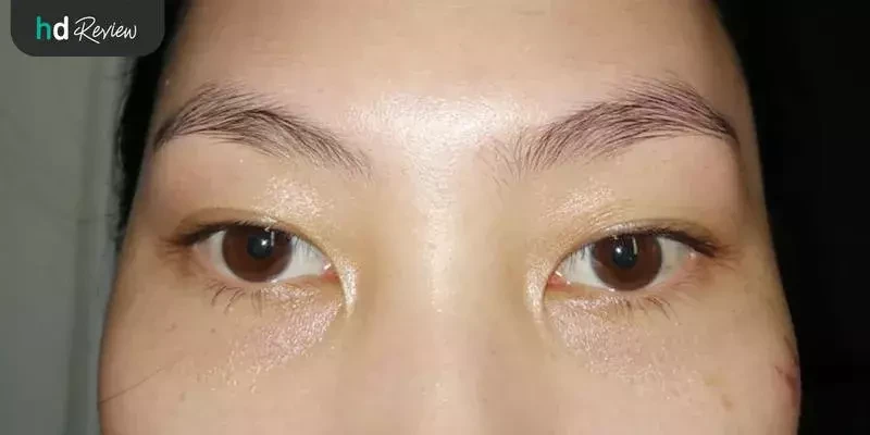 ภาพหลังทำคอนซีลเลอร์ ด้วยเลเซอร์ Fotona 4D ที่ รัตตินันท์คลินิก (Rattinan Clinic)