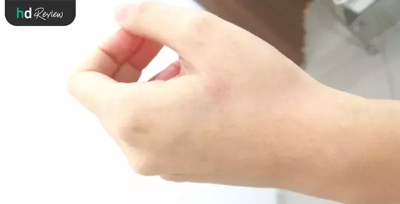 ขั้นตอนการฝังเข็ม