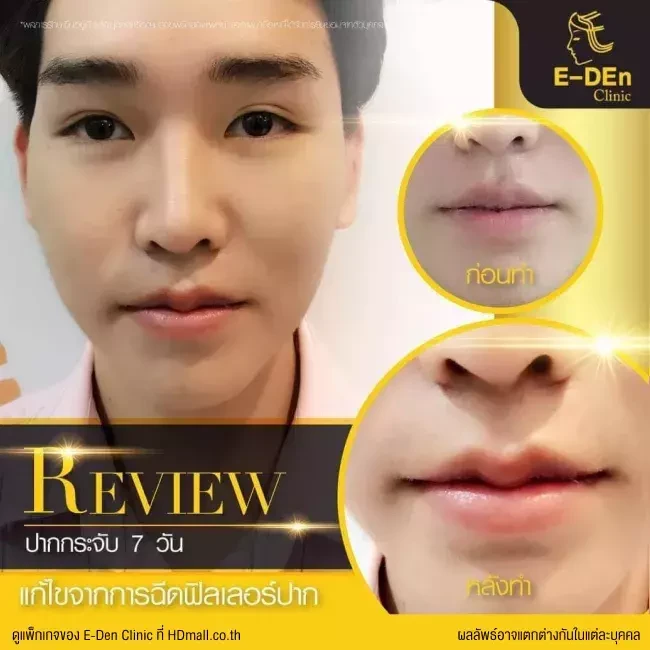 รีวิว ศัลยกรรม ปากกระจับ ที่ E-Den Clinic