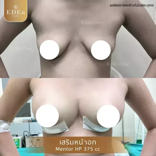 รีวิว เสริมหน้าอก ที่ E-Den Clinic