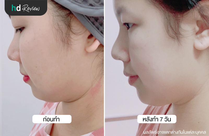 รีวิว Cryo V สลายไขมันเหนียงด้วยความเย็น ที่ Wink Clinic