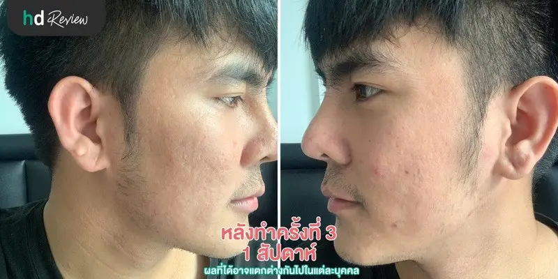 ภาพหลังทำครั้งที่ 3 1 สัปดาห์