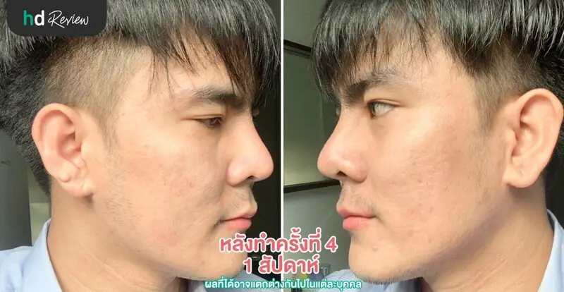ภาพหลังทำครั้งที่ 4 1 สัปดาห์