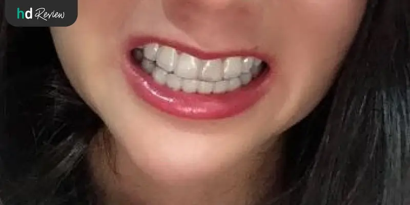 มั่นใจในรอยยิ้มใหม่ด้วยการจัดฟันแบบใสกับ Zenyum 7 ผลลัพธ์หลังจัดฟันแบบใสกับ Zenyum