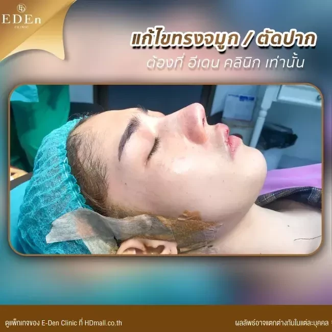 รีวิว เสริมจมูกแบบ Open เชียงใหม่ ที่ E-Den Clinic