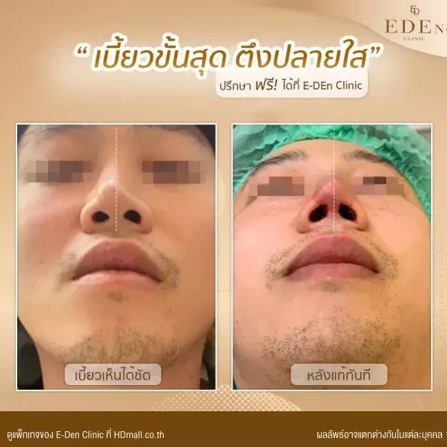 รีวิว เสริมจมูกแบบ Open เชียงใหม่ ที่ E-Den Clinic