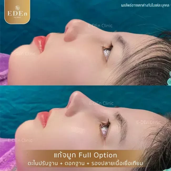 รีวิว เสริมจมูกแบบ Open เชียงใหม่ ที่ E-Den Clinic