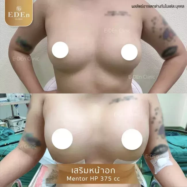 รีวิว เสริมหน้าอก ที่ E-Den Clinic