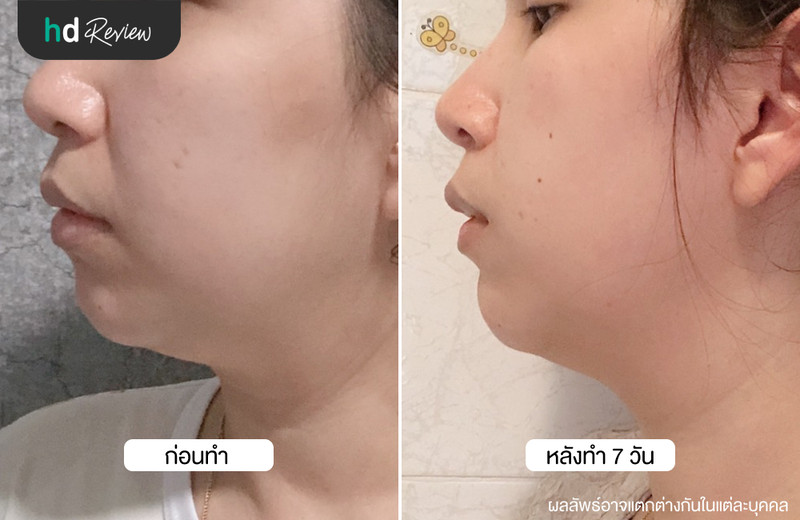 รีวิว Cryo V สลายไขมันเหนียงด้วยความเย็น ที่ Wink Clinic