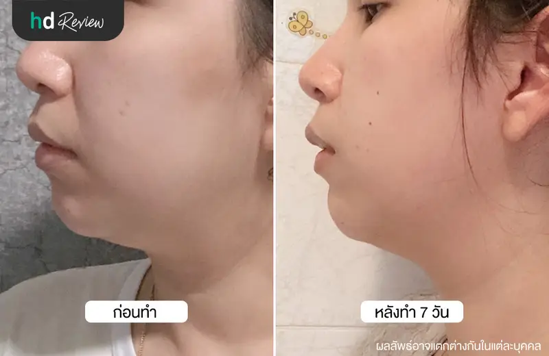 รีวิว Cryo V สลายไขมันเหนียงด้วยความเย็น ที่ Wink Clinic