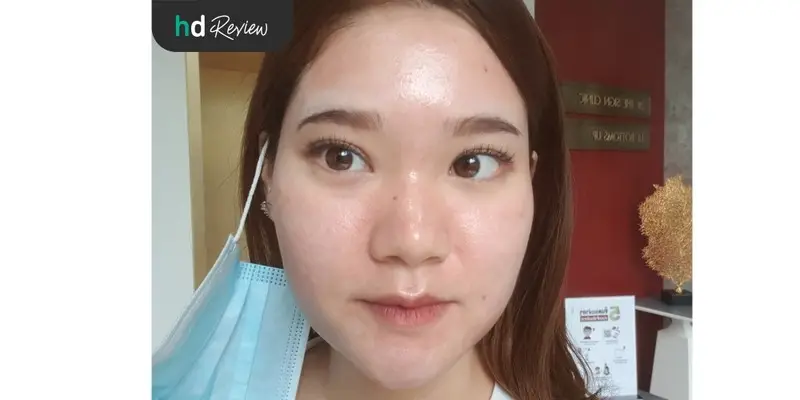 ภาพหลังทำเลเซอร์รักษารอยแผลเป็นจากสิวและหลุมสิวครั้งที่ 3 ที่ The Sign Clinic