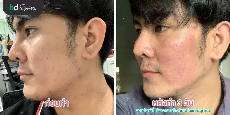 ภาพเปรียบเทียบก่อนทำกับหลังทำ 3 วัน