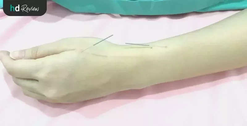 ขั้นตอนการฝังเข็ม