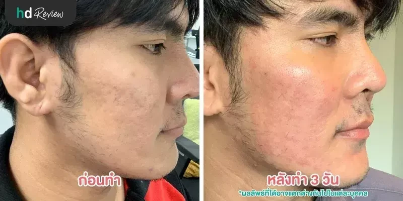 ภาพเปรียบเทียบก่อนทำกับหลังทำ 3 วัน