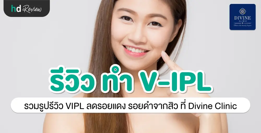 รีวิว ลดรอยสิว ด้วย V-IPL ที่ Divine Aesthetic Clinic