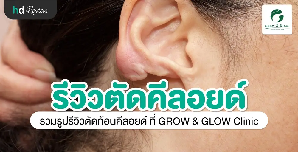รีวิวตัดคีลอยด์ ที่ GROW & GLOW Clinic