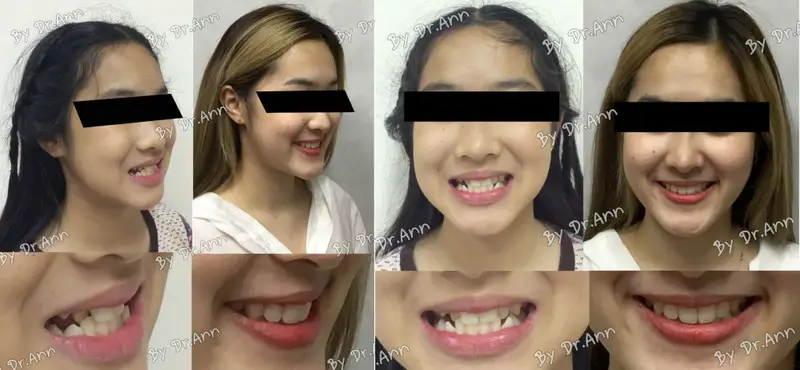 รีวิวจัดฟันแก้ปัญหาฟันล่างคร่อมฟันบน ที่ คลินิกฟันยิ้ม ราม 2