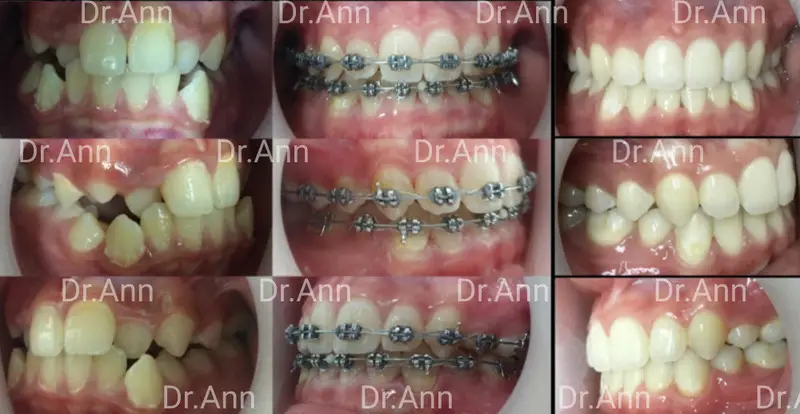 รีวิวจัดฟันแก้ปัญหาฟันล่างคร่อมฟันบน ที่ คลินิกฟันยิ้ม ราม 2