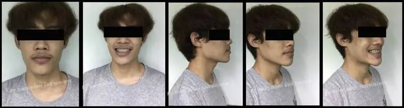 รีวิวจัดฟันแก้ปัญหาฟันล่างคร่อมฟันบน ที่ คลินิกฟันยิ้ม ราม 2