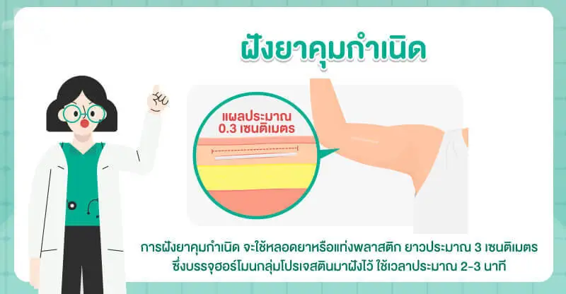 การฝังยาคุมกำเนิด