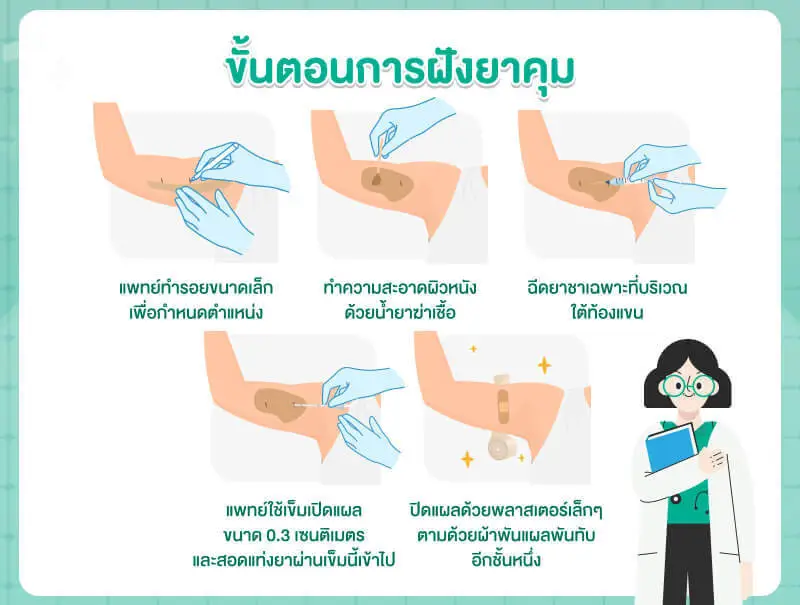ขั้นตอนการฝังยาคุมกำเนิด