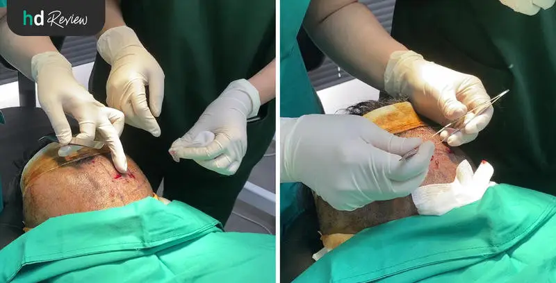 ขั้นตอนการปลูกผม ด้วยเทคนิค FUE ที่ GROW & Clinic วันที่ 2