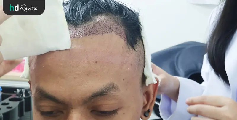 ขั้นตอนการปลูกผม ด้วยเทคนิค FUE ที่ GROW & GLOW Clinic วันที่ 3