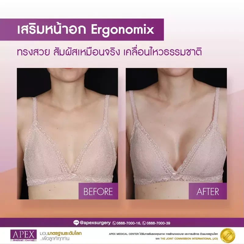 ิBefore After เสริมหน้าอกซิลิโคน Motiva Ergonomix