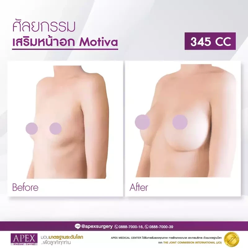 Before After เสริมหน้าอกซิลิโคน Motiva
