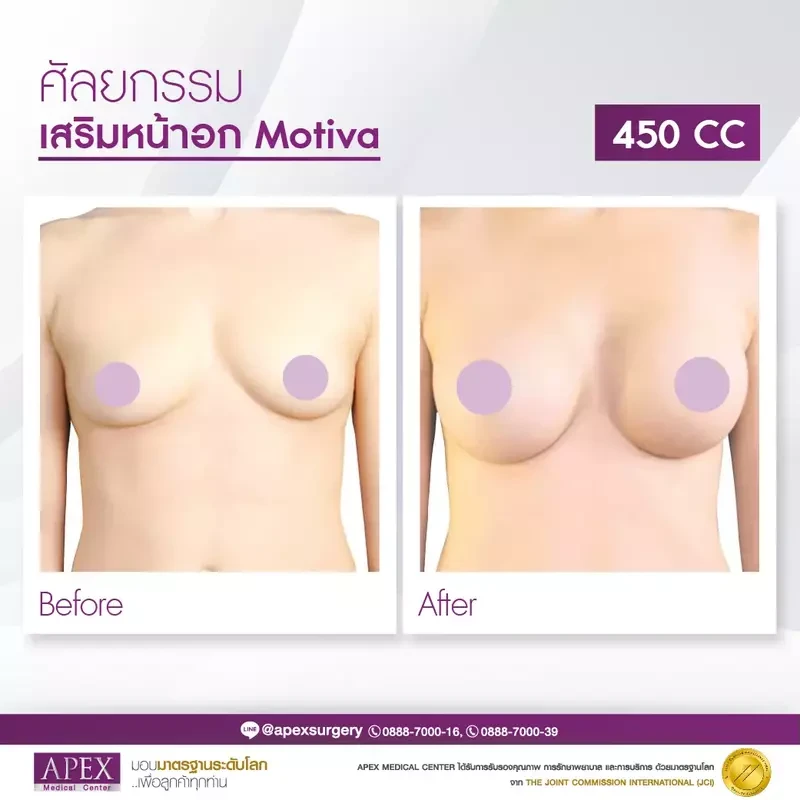 Before After เสริมหน้าอกซิลิโคน Motiva