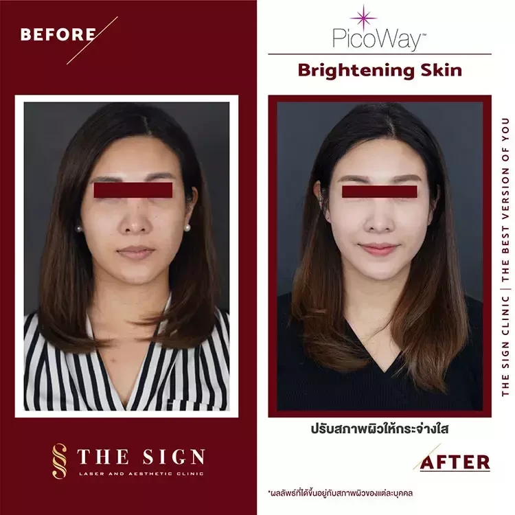 ภาพ Before After การทำ PicoWay ที่ The Sign Clinic