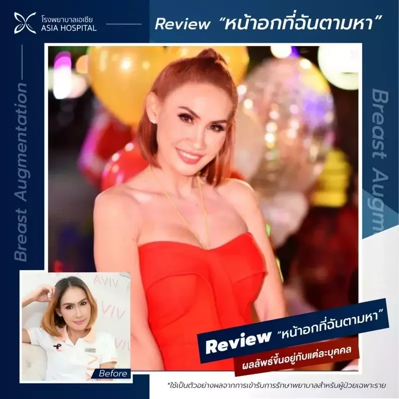 รีวิว เสริมหน้าอก ด้วยซิลิโคน Mentor ที่ โรงพยาบาลเอเซีย