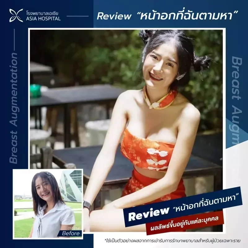 รีวิว เสริมหน้าอก ด้วยซิลิโคน Mentor ที่ โรงพยาบาลเอเซีย