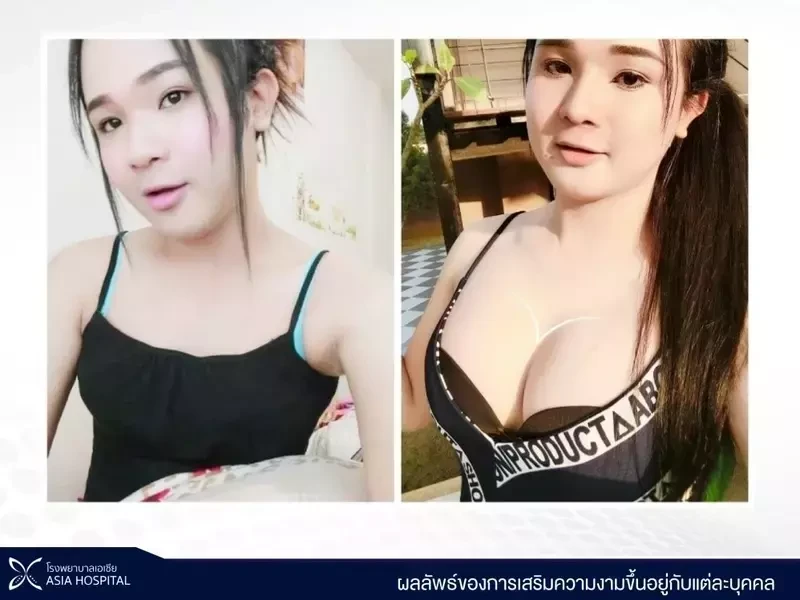ภาพเปรียบเทียบ Before-After เสริมหน้าอก ที่โรงพยาบาลเอเชีย