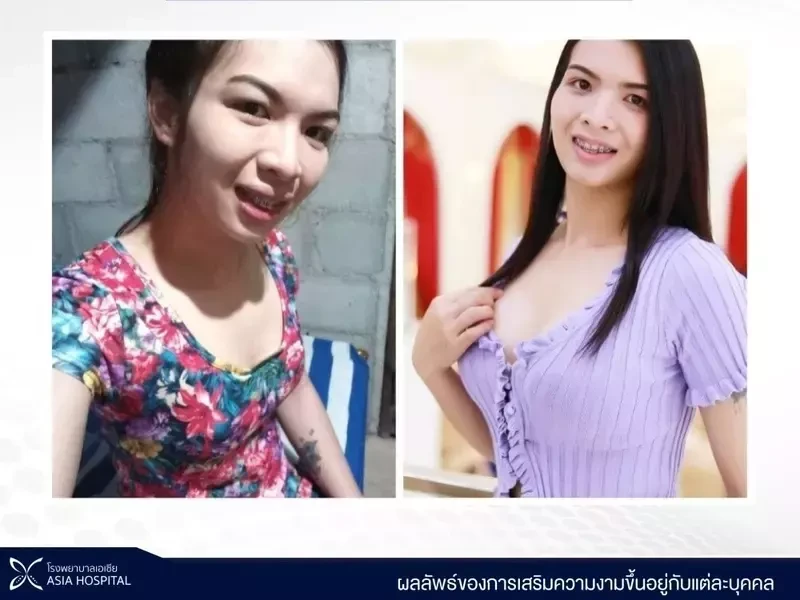 ภาพเปรียบเทียบ Before-After เสริมหน้าอก ที่โรงพยาบาลเอเชีย