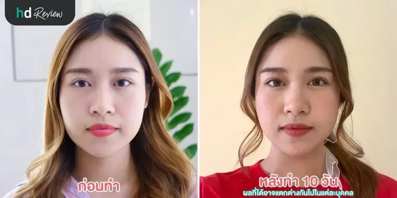 ภาพ Before After หลังฉีดโบเกาหลี ที่ Zenzen Clinic