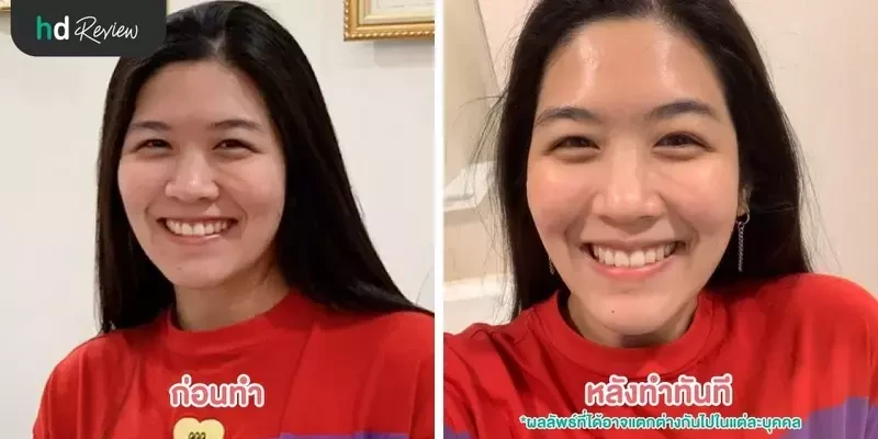 ภาพ Before After การทำทรีตเมนต์ ที่ Millennium Anti Aging Clinic