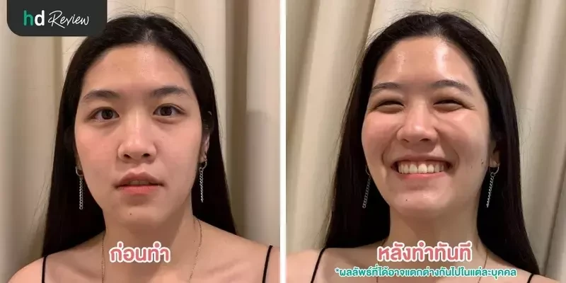ภาพ Before After การทำทรีตเมนต์ ที่ Millennium Anti Aging Clinic