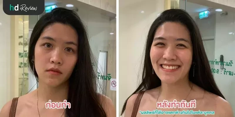 ภาพ Before After การทำทรีตเมนต์ ที่ Millennium Anti Aging Clinic