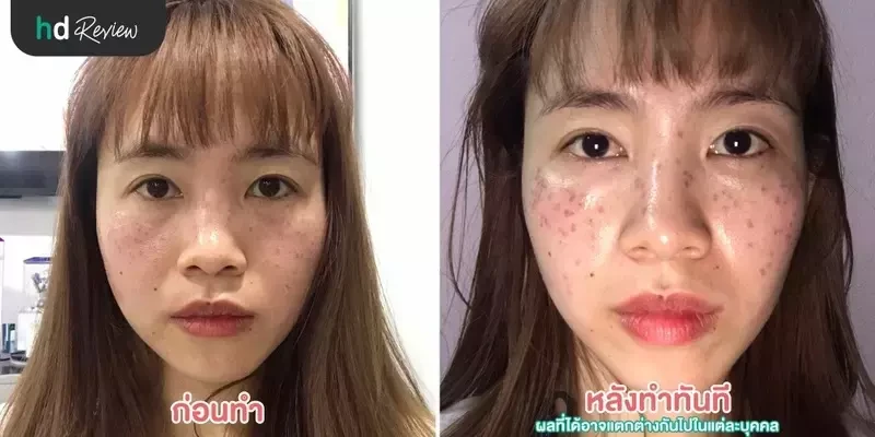 ภาพผลลัพธ์หลังทำเลเซอร์ ฝ้า กระ ด้วย Pico Way ที่ The Sign Clinic