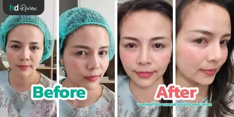 ภาพ Before After หลังทำเลเซอร์รักษาฝ้า กระ ด้วยเครื่อง Pico