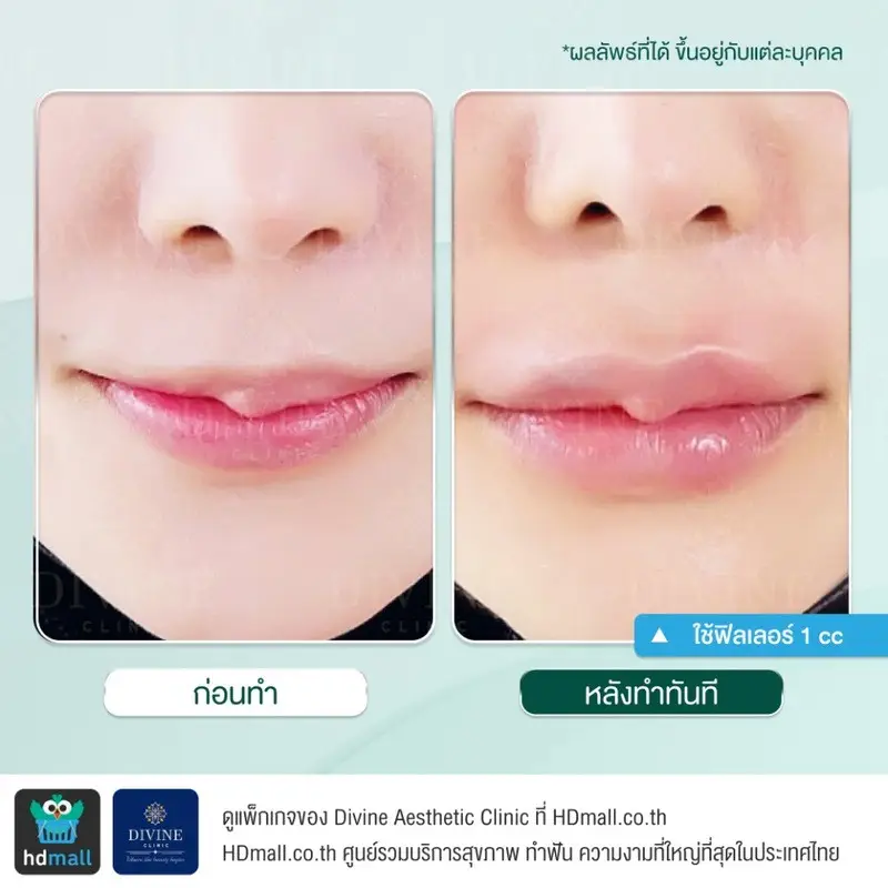 รีวิวฉีดฟิลเลอร์ปาก ที่ Divine Aesthetic Clinic