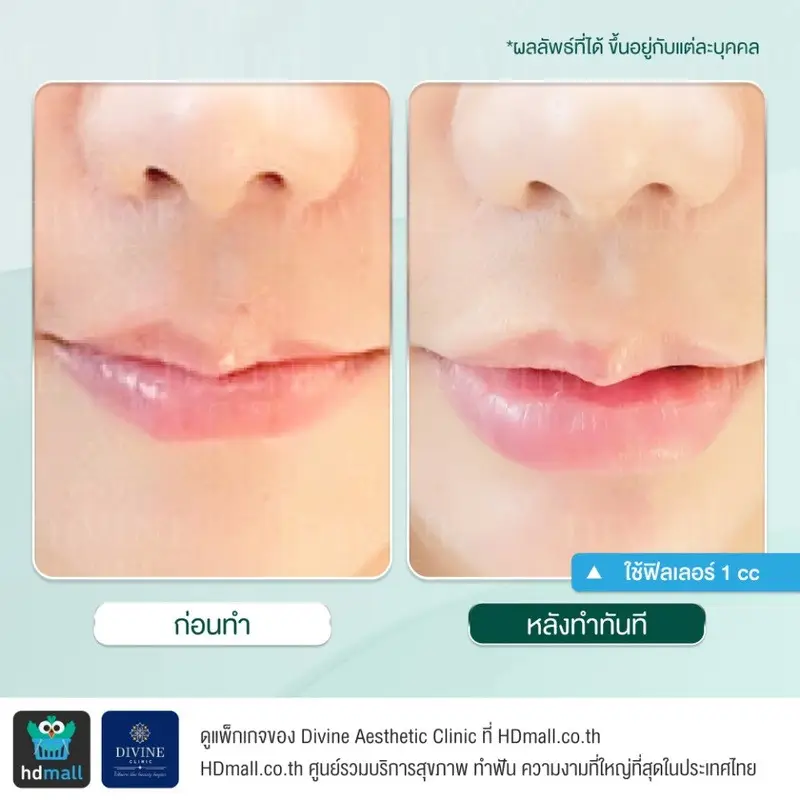 รีวิวฉีดฟิลเลอร์ปาก ที่ Divine Aesthetic Clinic