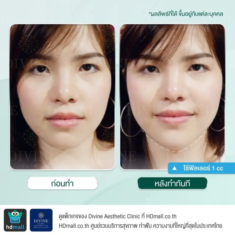 รีวิวฉีดฟิลเลอร์คาง ที่ Divine Aesthetic Clinic