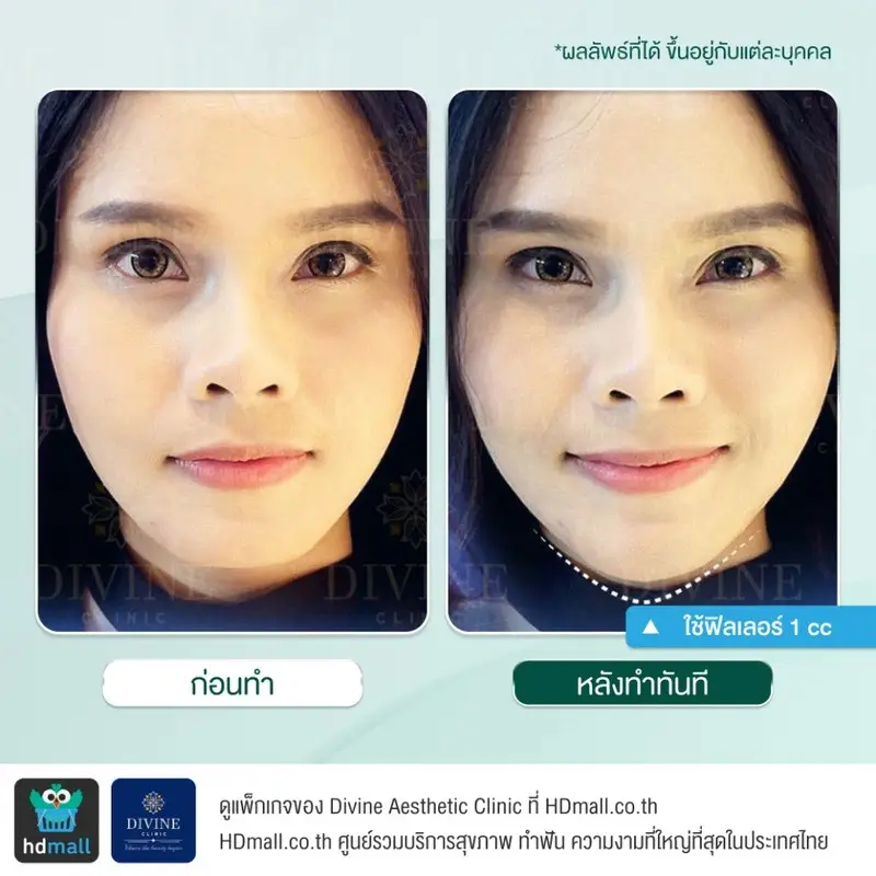 รีวิวฉีดฟิลเลอร์คาง ที่ Divine Aesthetic Clinic