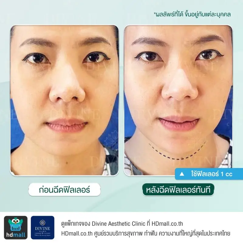 รีวิวฉีดฟิลเลอร์คาง ที่ Divine Aesthetic Clinic