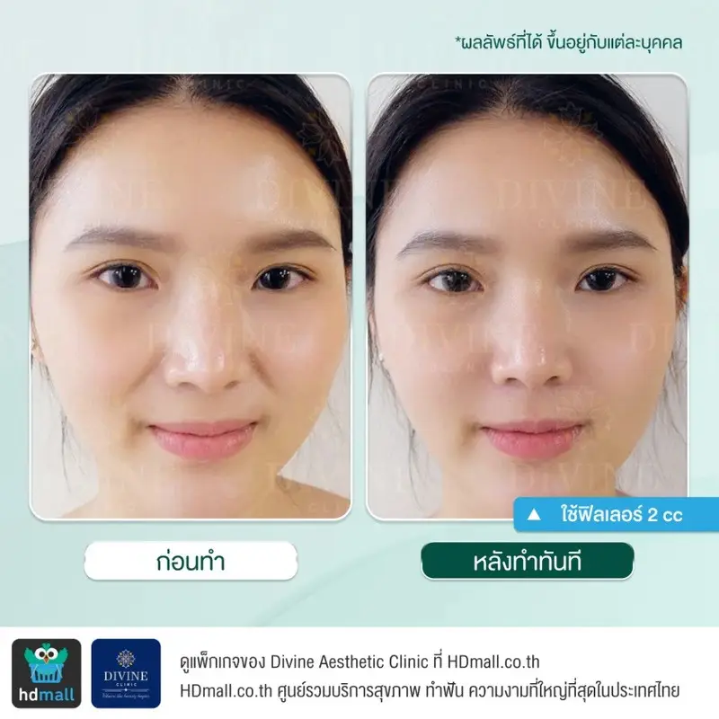 รีวิวฉีดฟิลเลอร์ร่องแก้ม ที่ Divine Aesthetic Clinic
