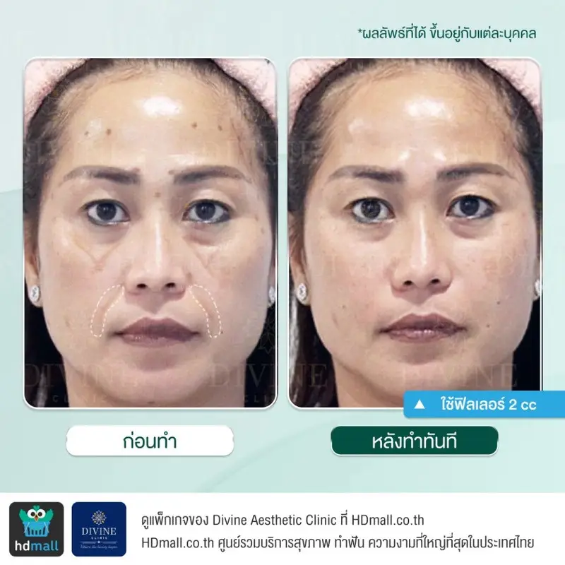 รีวิวฉีดฟิลเลอร์ร่องแก้ม ที่ Divine Aesthetic Clinic