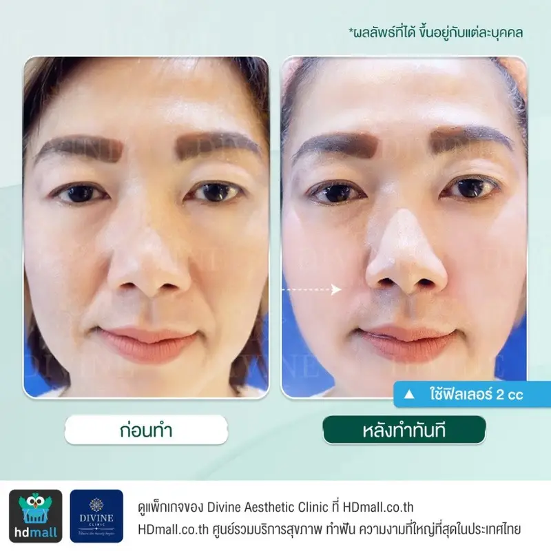 รีวิวฉีดฟิลเลอร์ร่องแก้ม ที่ Divine Aesthetic Clinic