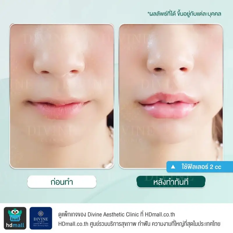 รีวิวฉีดฟิลเลอร์ปาก ที่ Divine Aesthetic Clinic